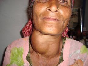 <p><strong>SF Fig. 2.16.</strong> Woman with goiter, an enlarged thyroid gland, in India</p>