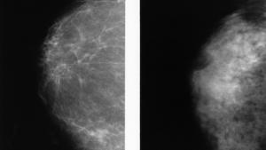 Two normal mammograms showing the difference between a dense breast (left) and a fatty breast (right). PC: National Cancer Institute