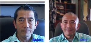 Before and after shots of Dr. Shiramizu from a prior "Shave-Off" fundraiser.